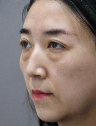 去眼袋手术