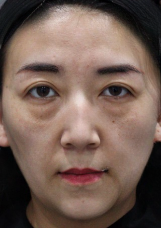 去眼袋手术