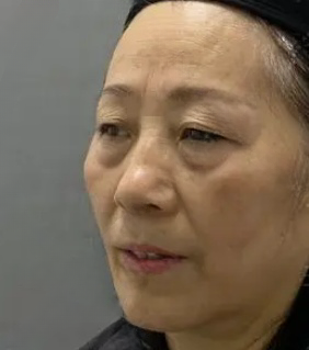 去眼袋手术