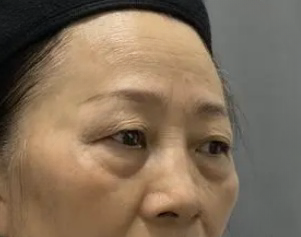 去眼袋手术
