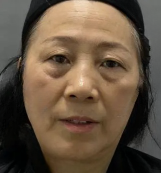 去眼袋手术