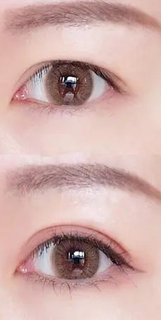 双眼皮手术