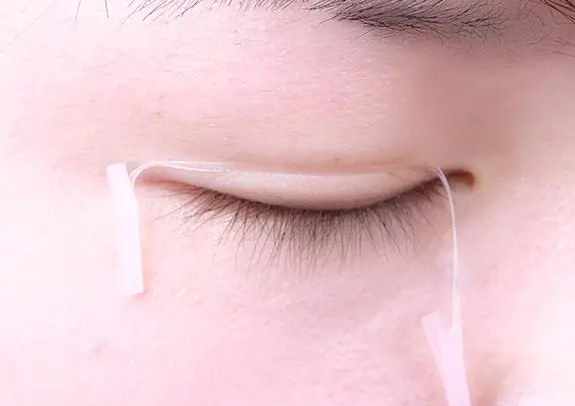 双眼皮手术