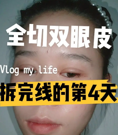 双眼皮手术