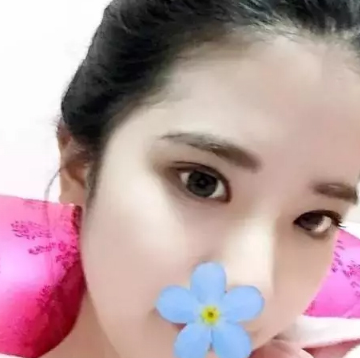 双眼皮手术