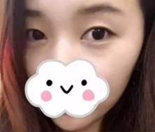 双眼皮手术