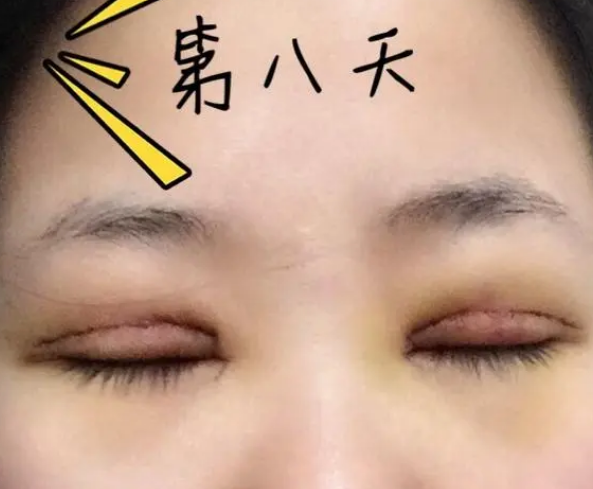 双眼皮手术