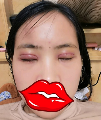 双眼皮手术