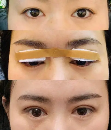 双眼皮手术