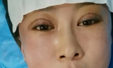 双眼皮手术