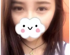 双眼皮手术
