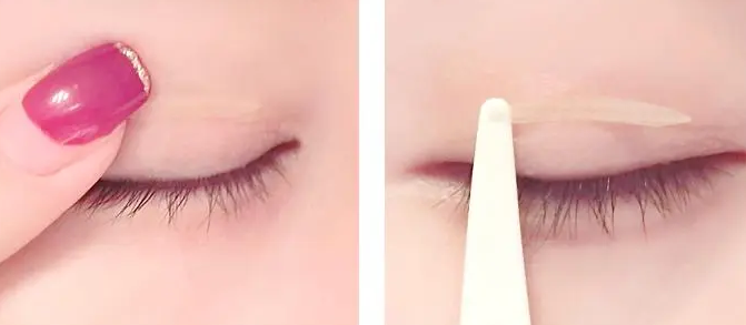 双眼皮手术