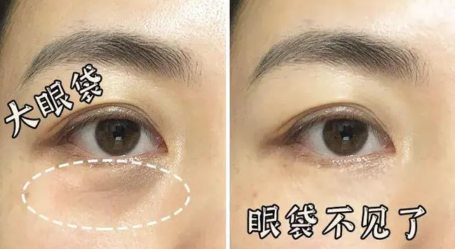 眼袋