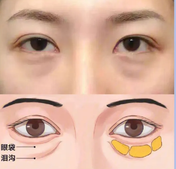 眼袋