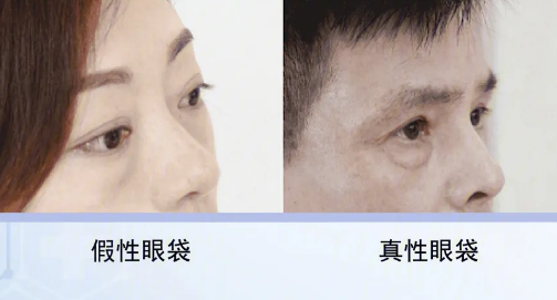眼袋