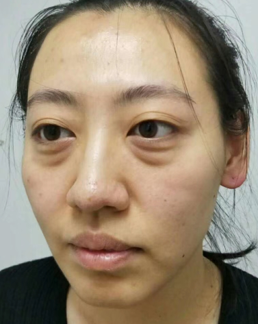 眼袋