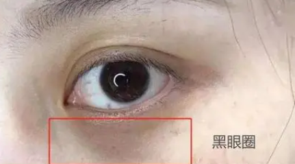 眼袋