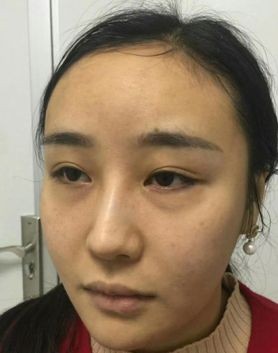 眼袋