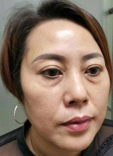 眼袋