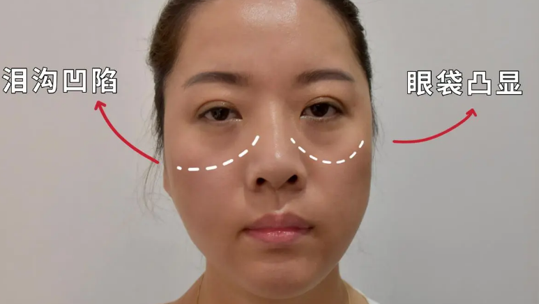 去眼袋手术