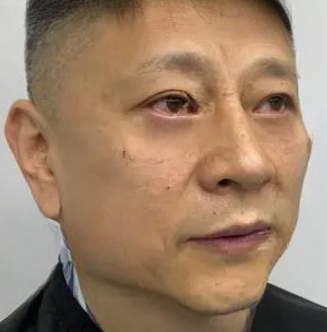 去眼袋手术