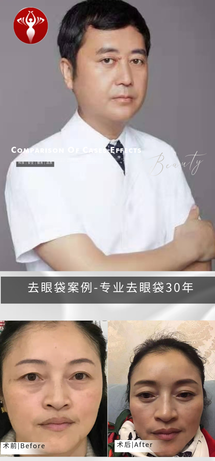 去眼袋手术