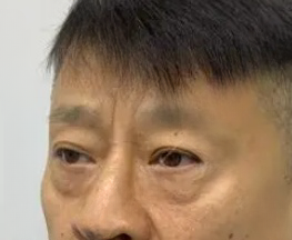 去眼袋手术