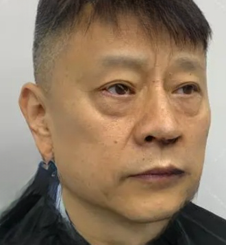 去眼袋手术