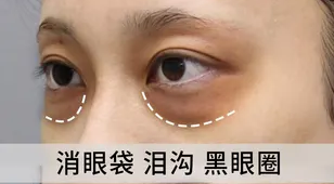 泪沟填充