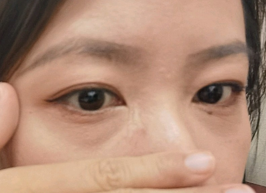 泪沟填充