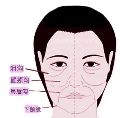 泪沟填充
