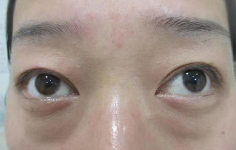 去眼袋手术