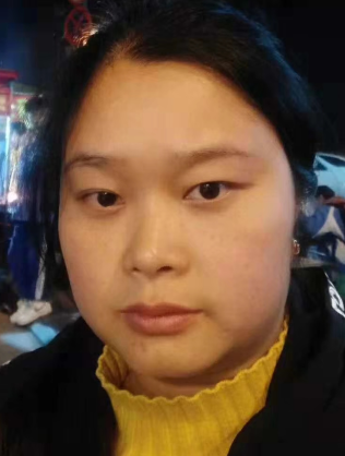 去眼袋手术