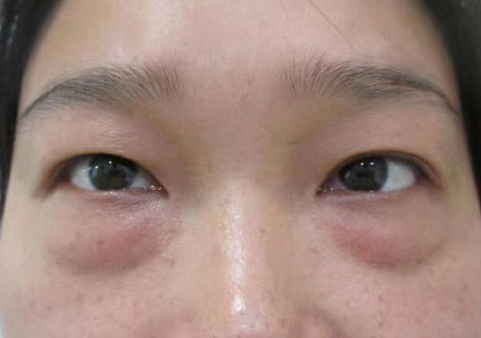 去眼袋手术