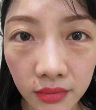 眼袋