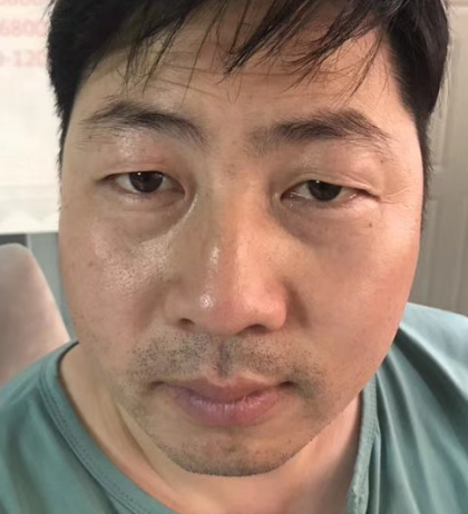 眼袋