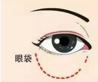 眼袋