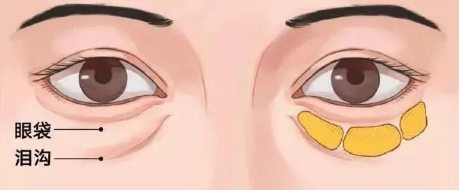 去眼袋手术