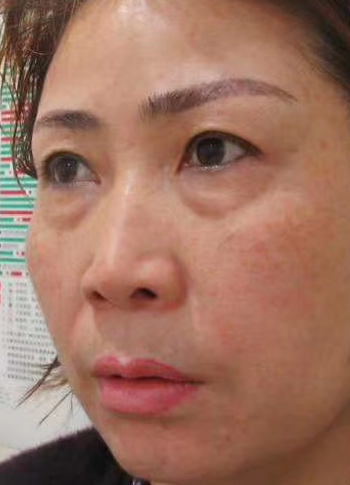 眼袋