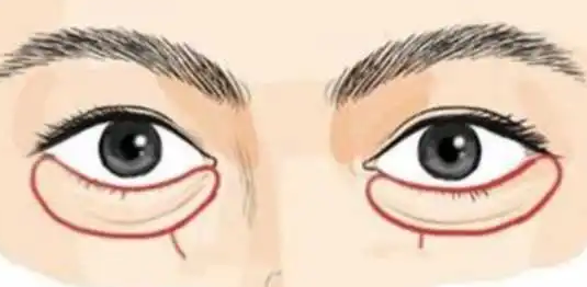 眼袋