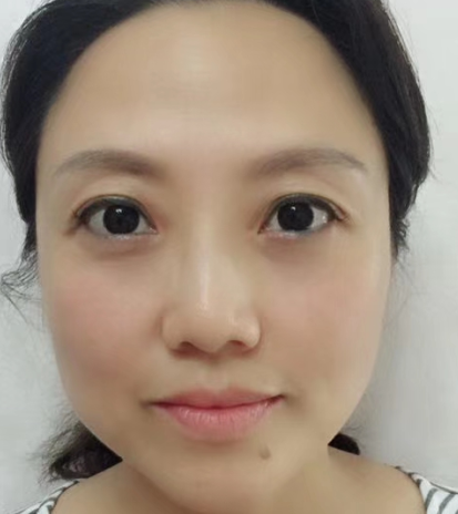 去眼袋手术