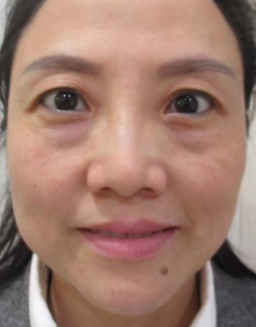 去眼袋手术