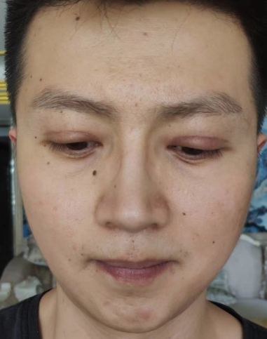 去眼袋手术