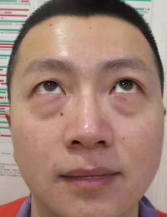 去眼袋手术