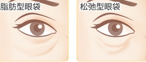 去眼袋手术