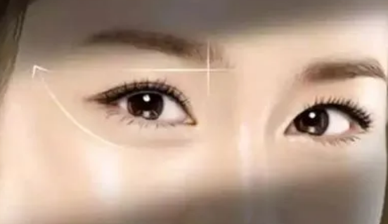 外切眼袋