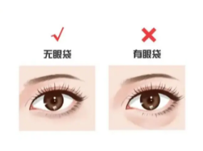 外切眼袋
