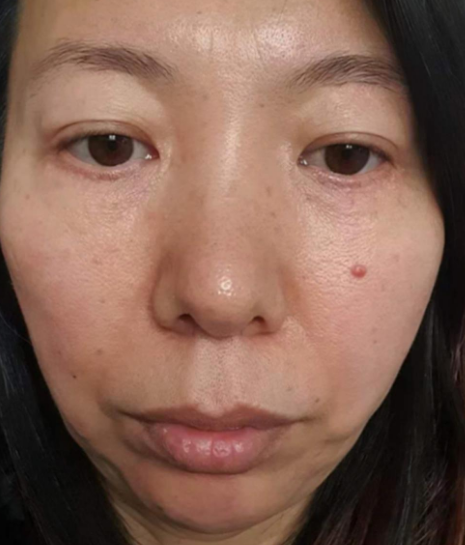 眼袋手术
