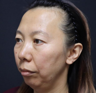 眼袋手术