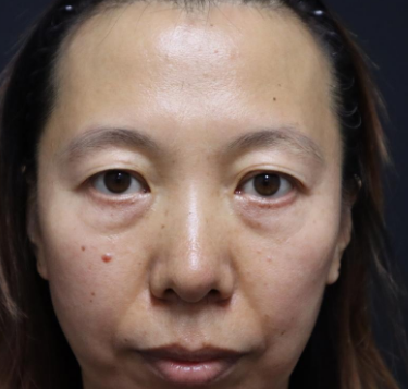 眼袋手术